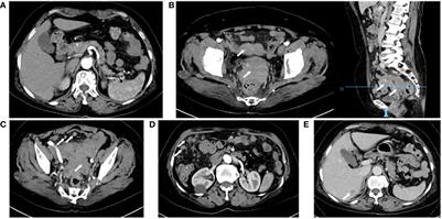 Ovarian cancer with intestinal wall invasion and hyperamylasemia: a case report